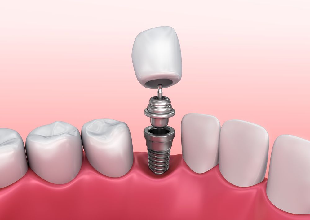 Dental implant-supported crown