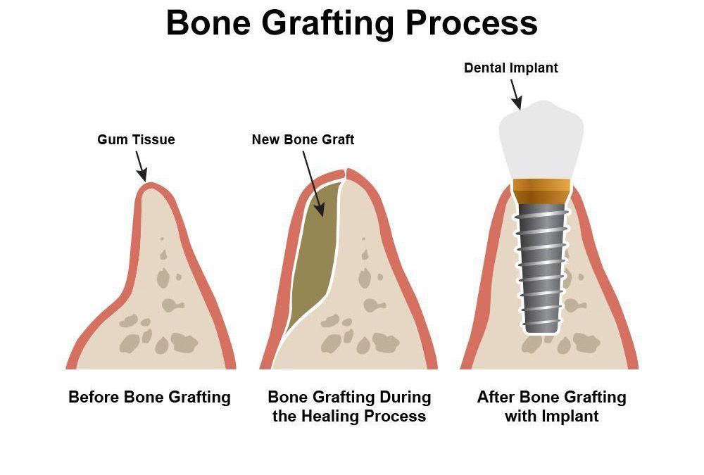 Illustration of bone grafting