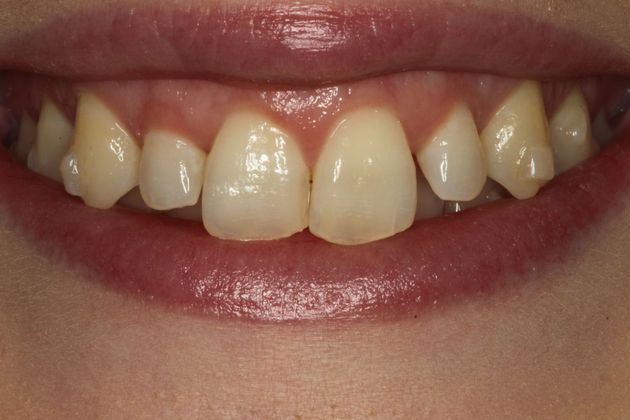 Dr. Byron J. Nordhus's Patient Before Veneers