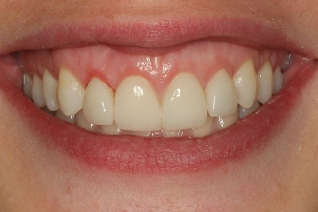 Dr. Byron J. Nordhus's Patient After Veneers